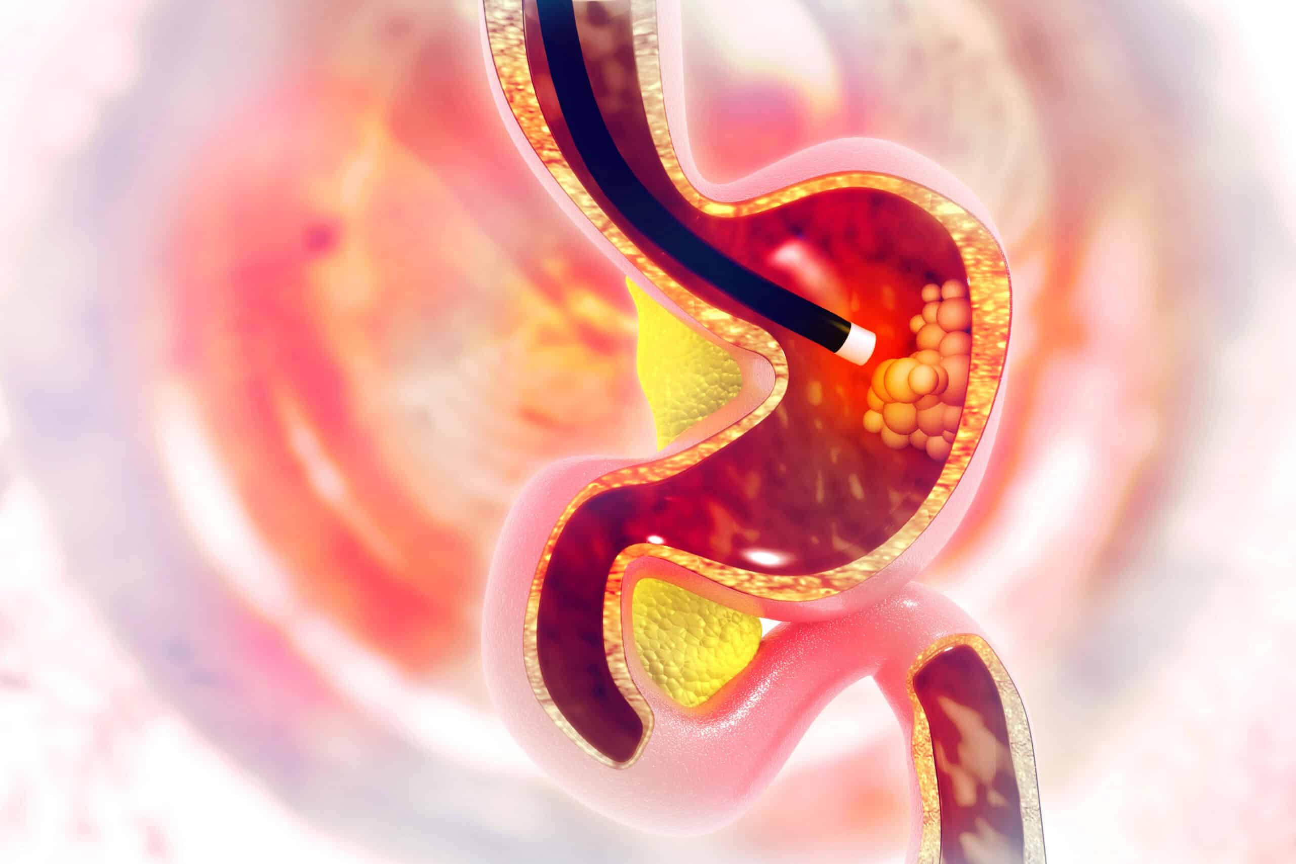 TROUBLE SWALLOWING ENDOSCOPY