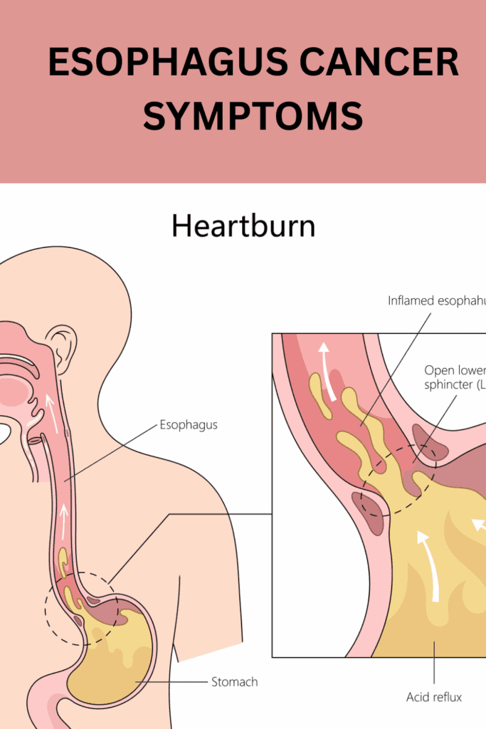 CONSTIPATION ESOPHAGUS SYMPTOMS