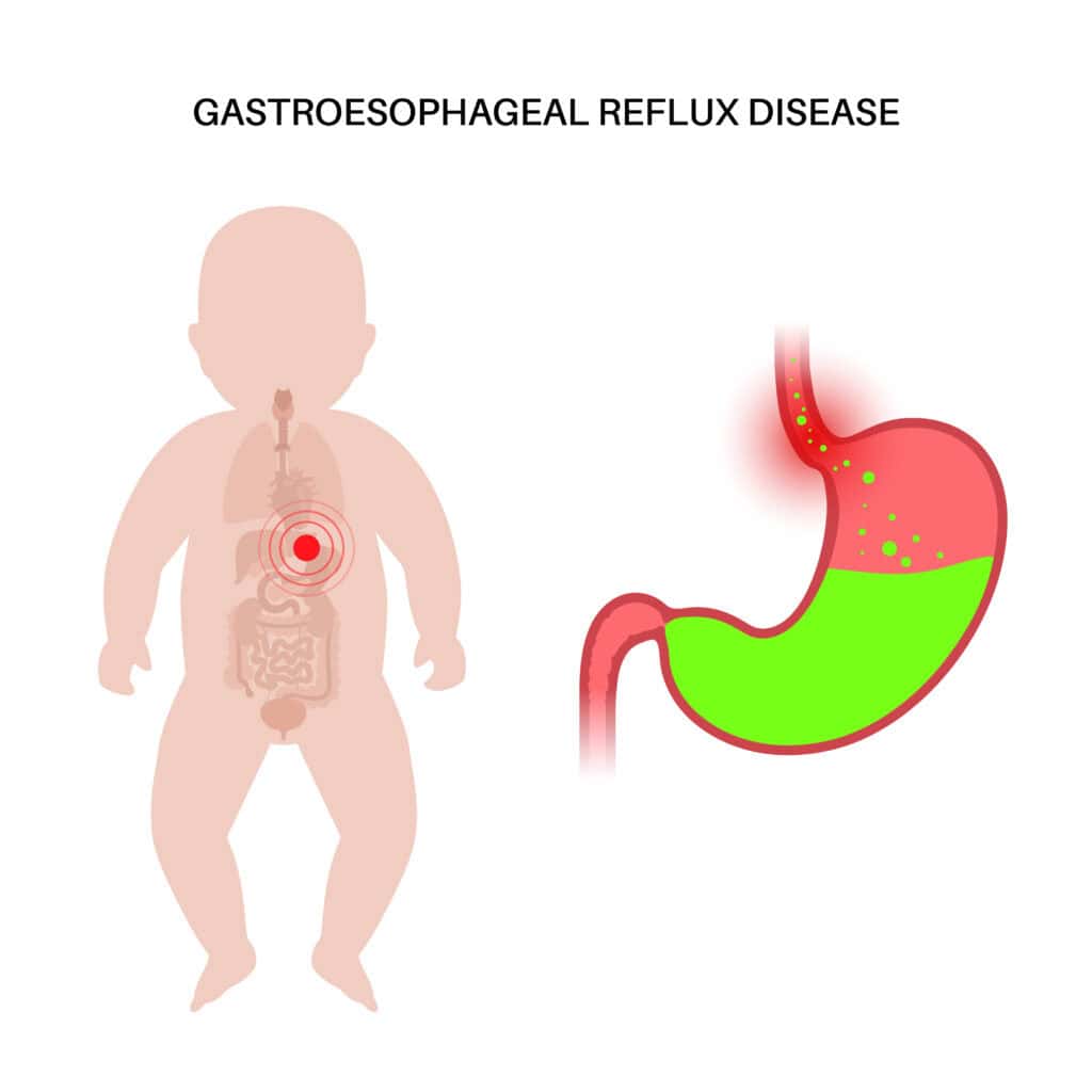 esophagus stenosis esophageal stricture