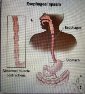 esophagus spasm guide