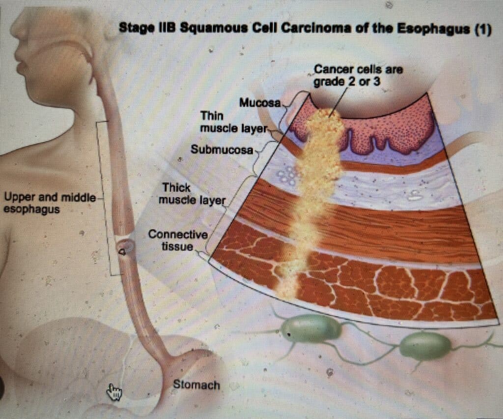 esophagus carcinoma esophageal adenocarcinoma