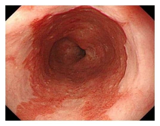 symptoms of barrett esophagus