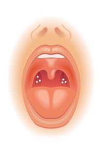 anastomosed definition