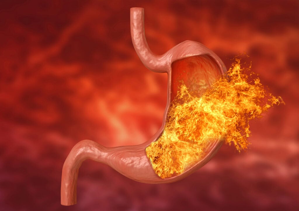 15 no nonsense signs of esophageal varices