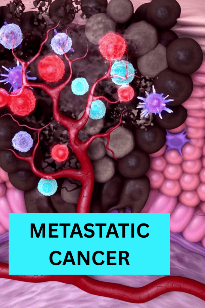 advanced esophageal cancer treatment