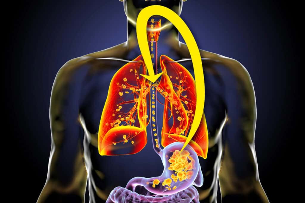 septic inflamed lungs with esophagus cancer septic lung disease