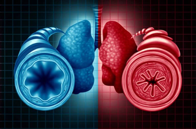 7 Powerful Truths About Asthma After Esophageal Cancer Nobody Warned You About