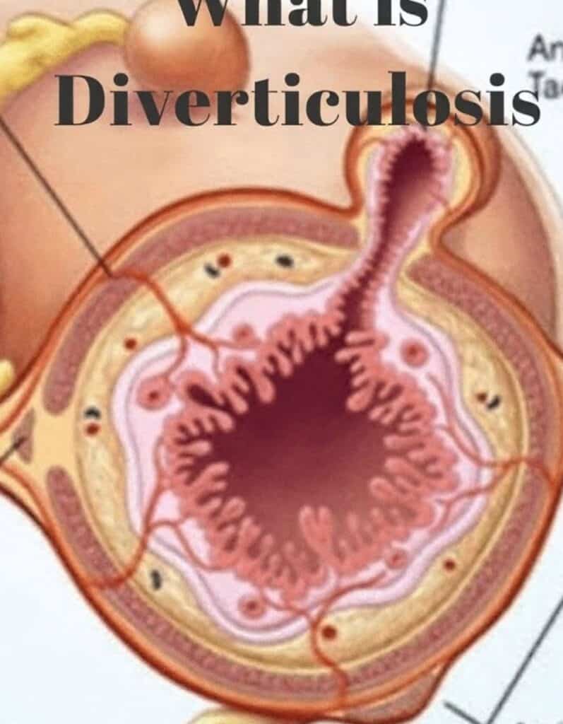 diverticulitis diverticulitis treatment