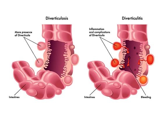diverticulitis acute diverticulitis