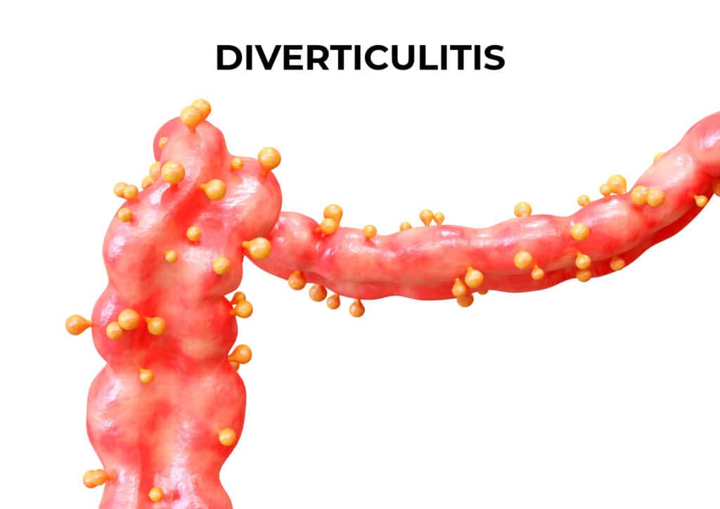 diverticulitis diverticulitis diet
