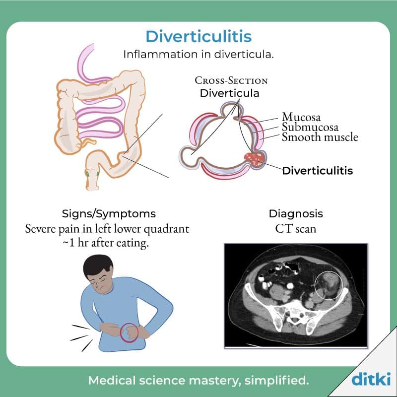 diverticulitis diverticulitis causes