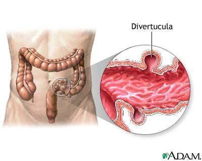 diverticulitis diverticulitis flare up