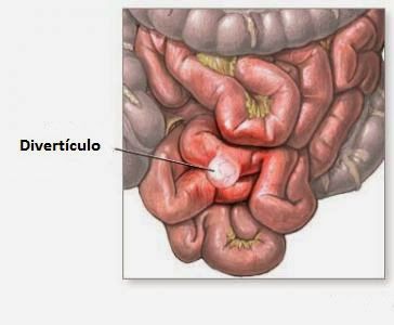 diverticulitis diverticulitis pain
