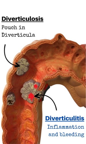 diverticulitis sigmoid diverticulitis